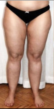 Lipedema Estágio 1
