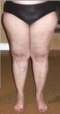 Lipedema Estágio 2