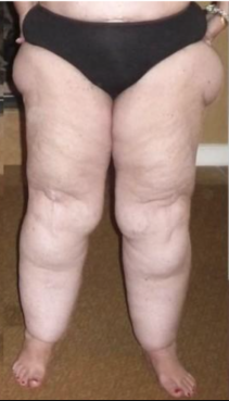 Lipedema Estágio 3